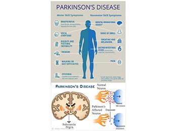 Parkinson’s Disease