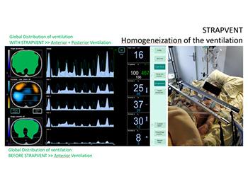 PULMONARY VENTILATION REGIONALIZATION OPTIMIZATION DEVICE BY TITRATION EXTRATHORACIC POSITIVE PRESSURE